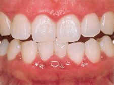 歯周炎の歯肉