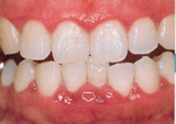 初診の歯と歯茎