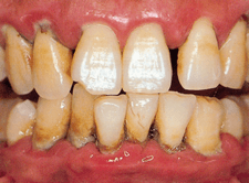 重度歯周炎の歯肉
