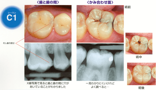虫歯のC1