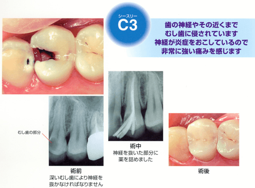 虫歯のC3