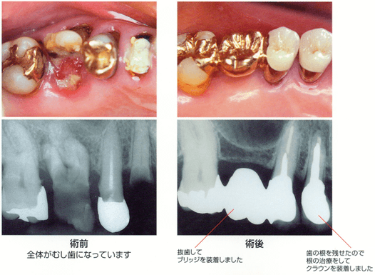 虫歯のC4