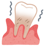 歯周病の歯茎のイラスト