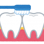 歯間部の歯垢のイラスト
